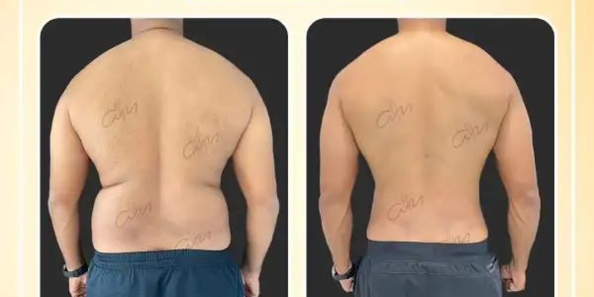 Liposuction in Dubai: Reshape Your Confidence with Dr. Hans Plastic Surgeon