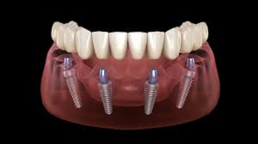 Blogs - Bang Box online - Is Full Mouth Implant Surgery Right for You?