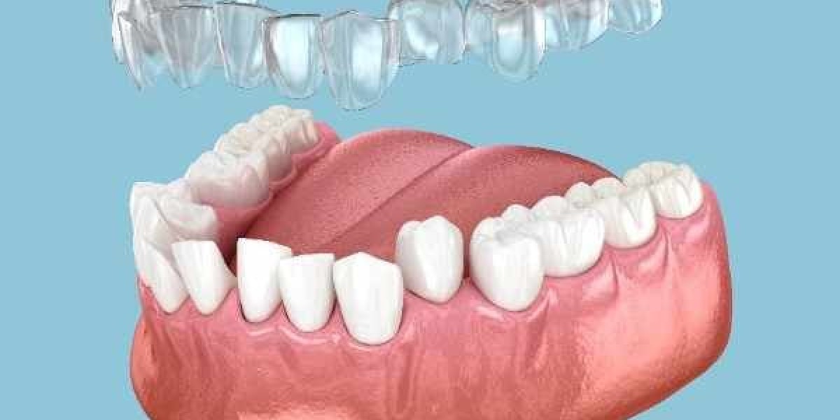 From First Tray to Final Smile An Invisalign Experience
