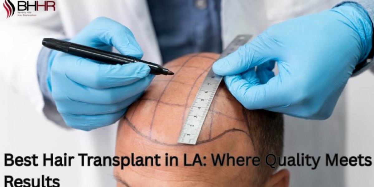 Best Hair Transplant in LA: Where Quality Meets Results