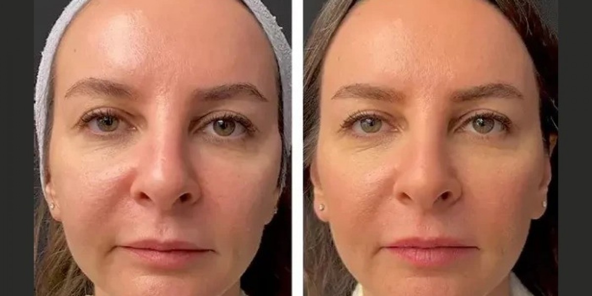 Best Doctors in Dubai Share Mesotherapy Safety Tips