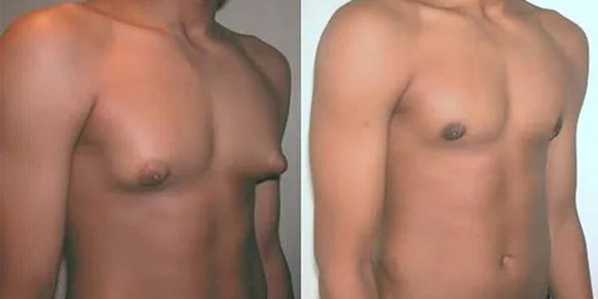 Gynecomastia In Bangalore
