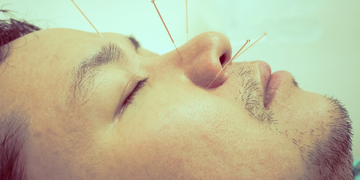 What Contributes to the Popularity of Cosmetic Acupuncture Calgary Treatments?