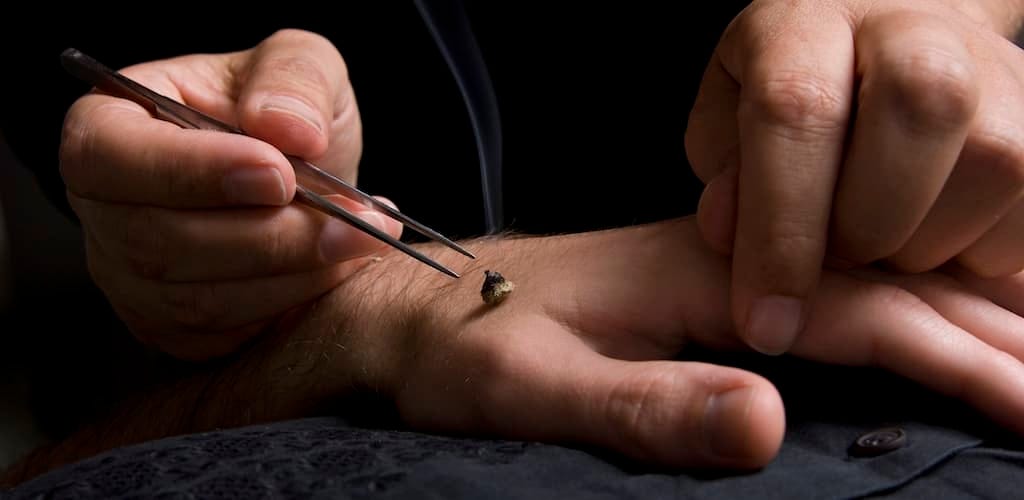 Healing through Matlock Acupuncture: A natural approach to pain Relief | by He Acupuncture | Nov, 2025 | Medium