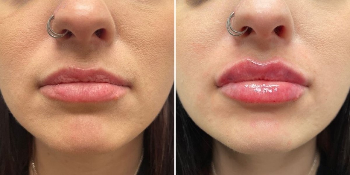 Lip Augmentation Islamabad: Plump Up Your Confidence