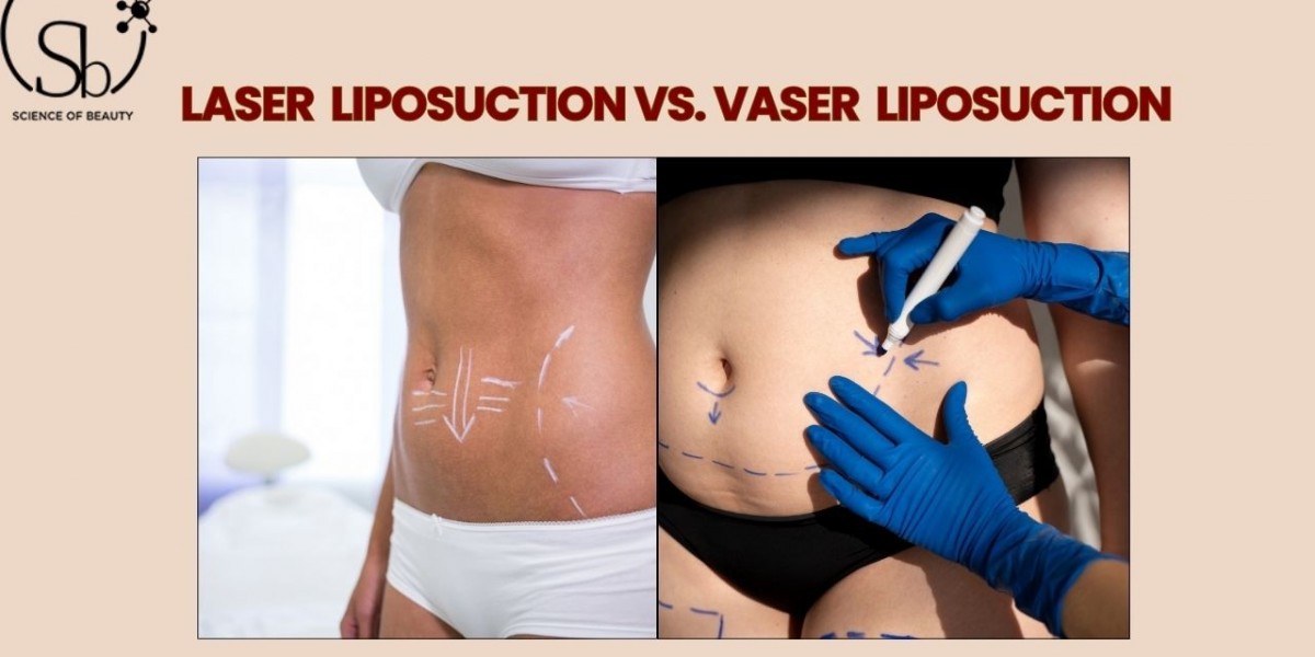 Laser Liposuction vs. Vaser Liposuction: Which One Should You Choose?