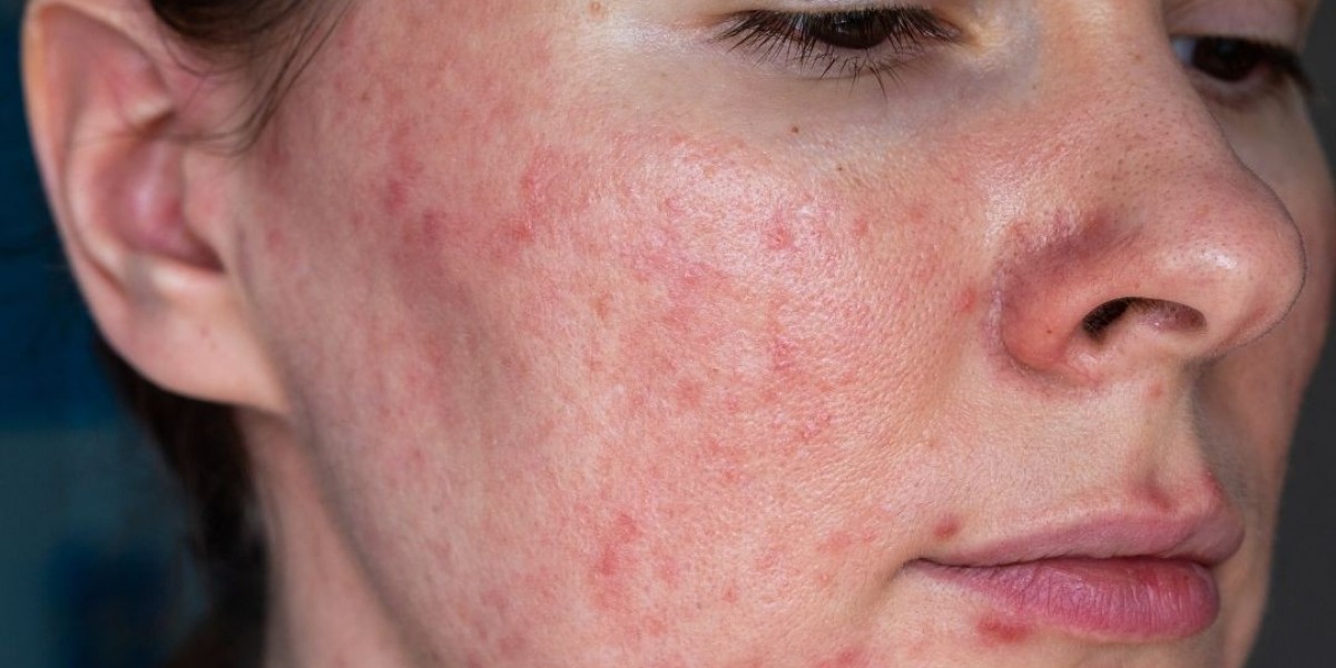 Pigmentation Treatment in Riyadh: Targeting Spots, Enhancing Glow