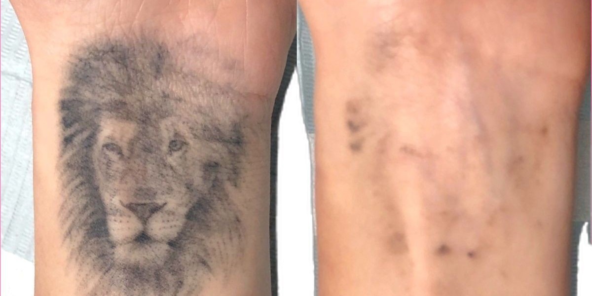 إزالة الوشم بالليزر لتحسين مظهر البشرة واستعادتها