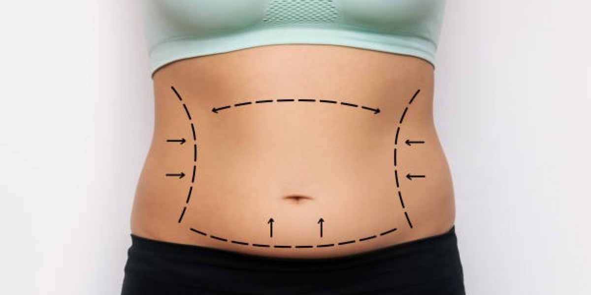 BodyTite Liposuction Delivers Natural Firmness