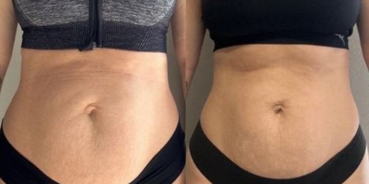 Liposuction in Islamabad – A Complete Guide to Body Contouring