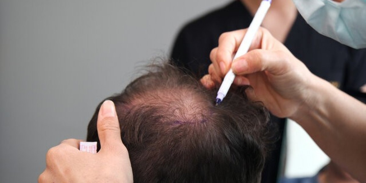 Pros and Cons of Hair Transplant