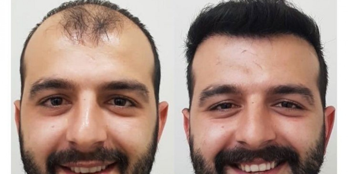Why Hair Transplant is a Preferred Solution