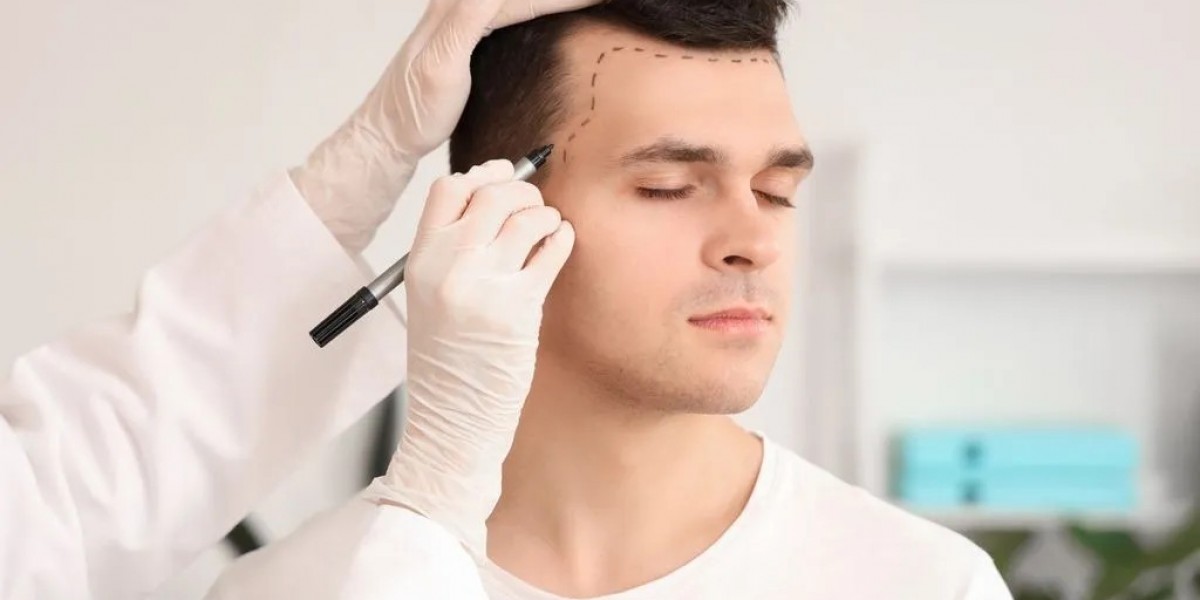 From Consultation to Completion: Your Hair Transplant Timeline