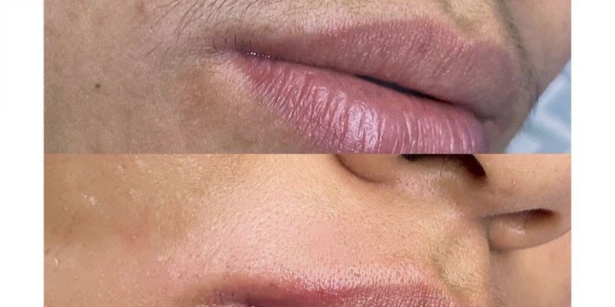 Permanent Laser Hair Removal – The Smart Way to Stay Hair-Free