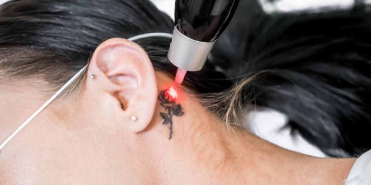 Laser Tattoo Removal: Black Ink Vanishes Fast