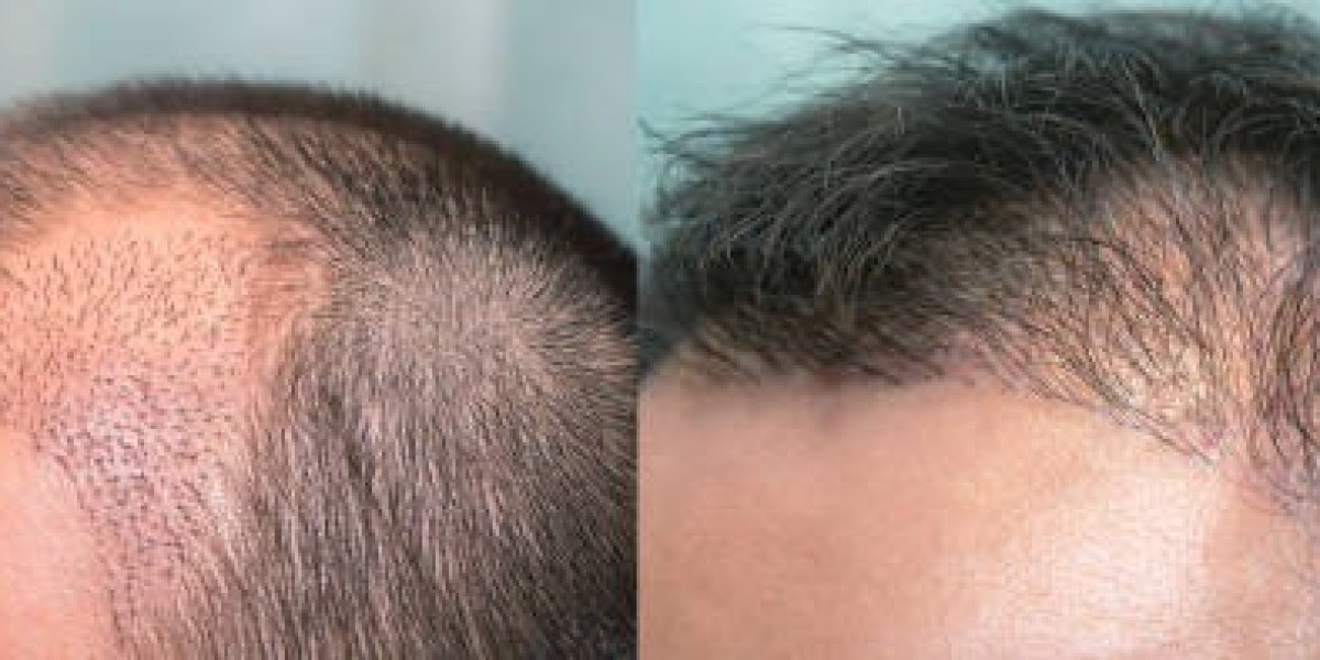 Advanced Hair Transplant Options in Riyadh for Men