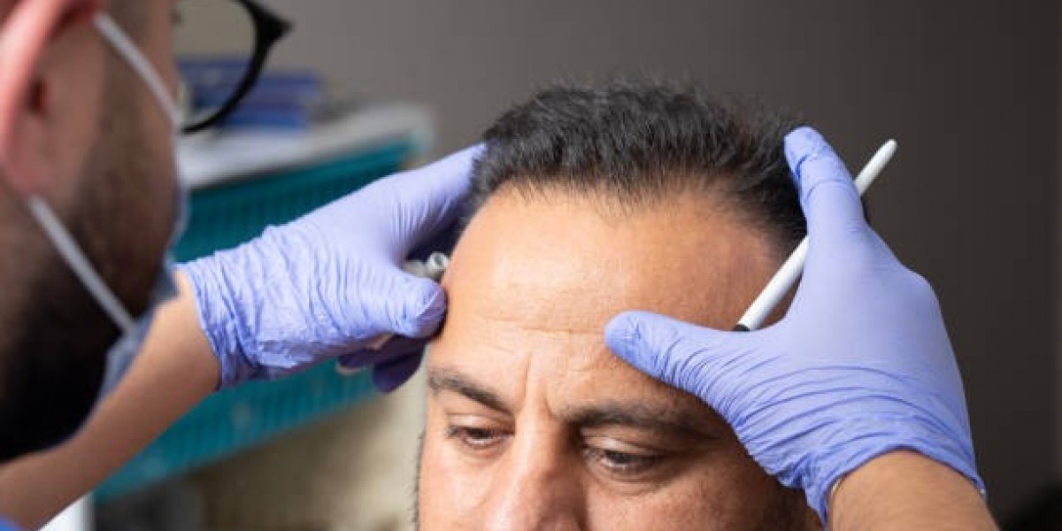 Mistakes to Avoid During Hair Transplant in Riyadh