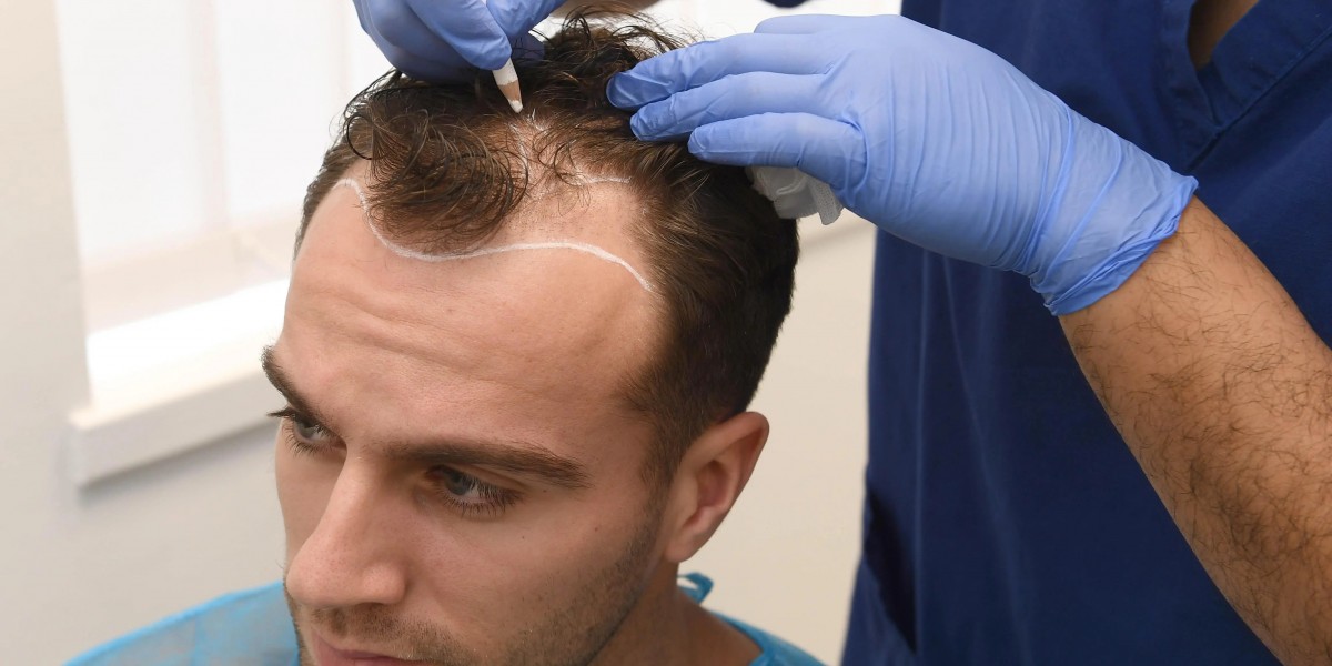 Hair Transplant in Islamabad – Medical Grade Hair Restoration