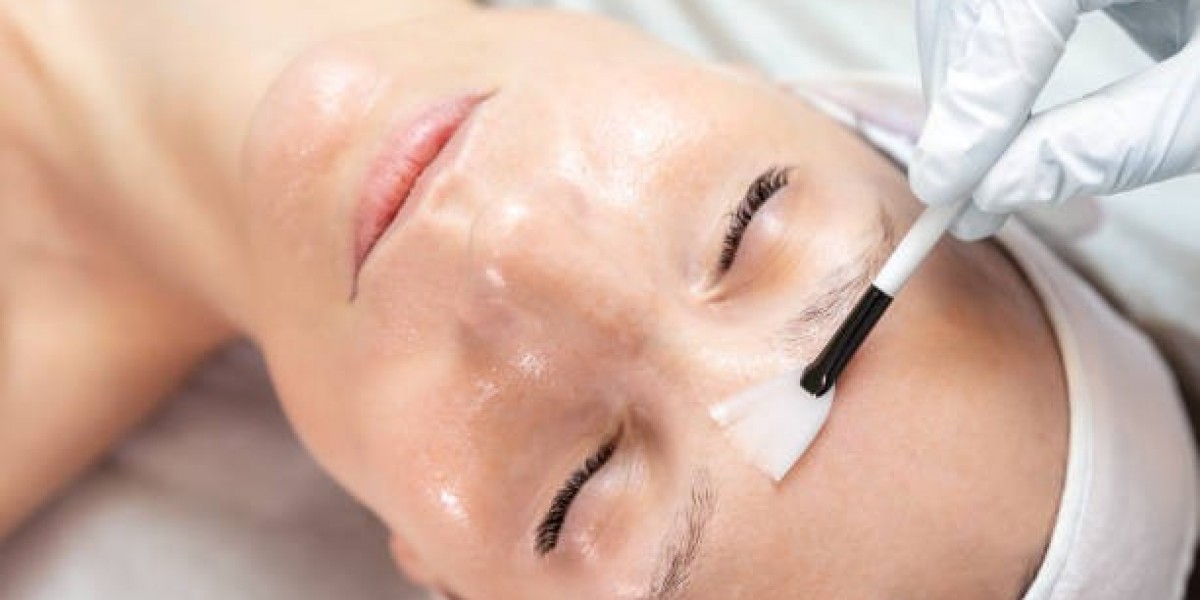Chemical Peels for Pore Minimizing and Skin Clarity