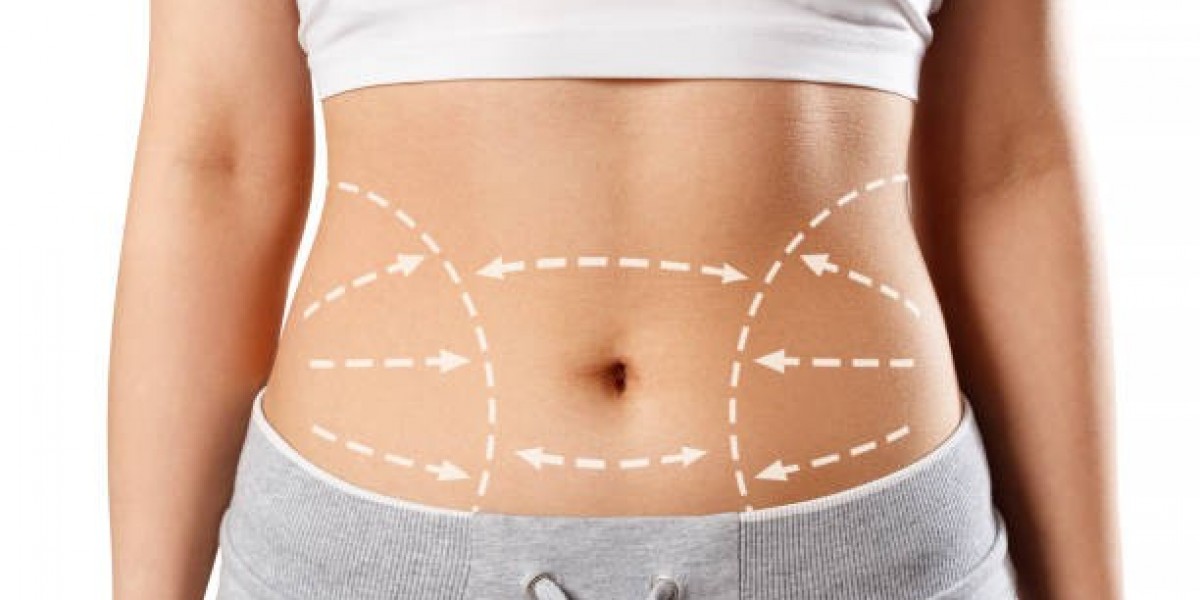 Liposuction Procedure for Hip Dips Correction