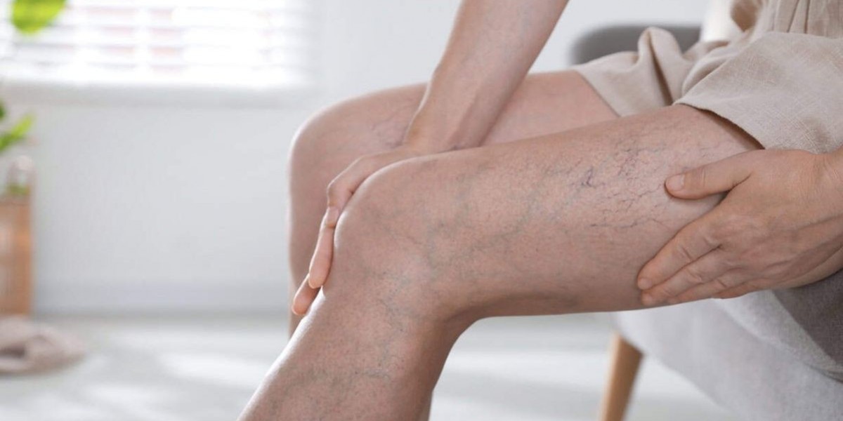 Understanding the Benefits of Timely Varicose Veins Treatment