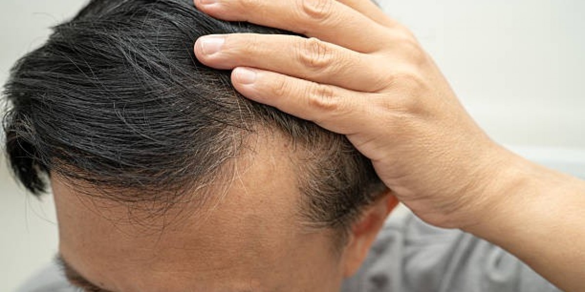 Restore Confidence Through Exosomes Therapy for Hair Loss Methods