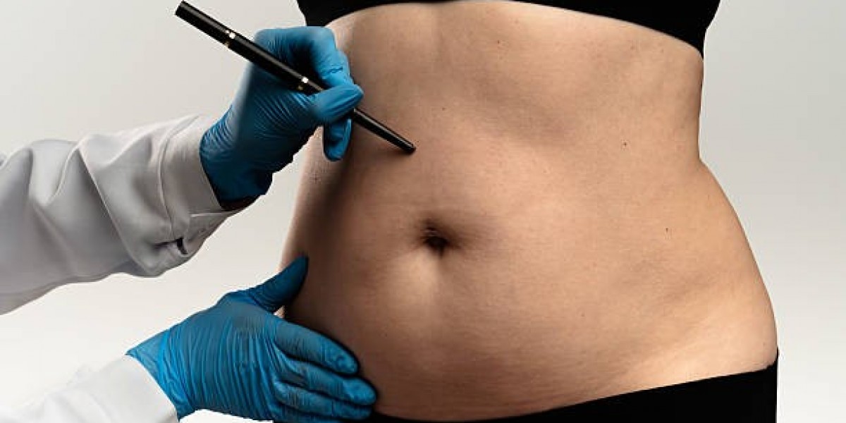 Redefine Your Body with Liposuction in Islamabad