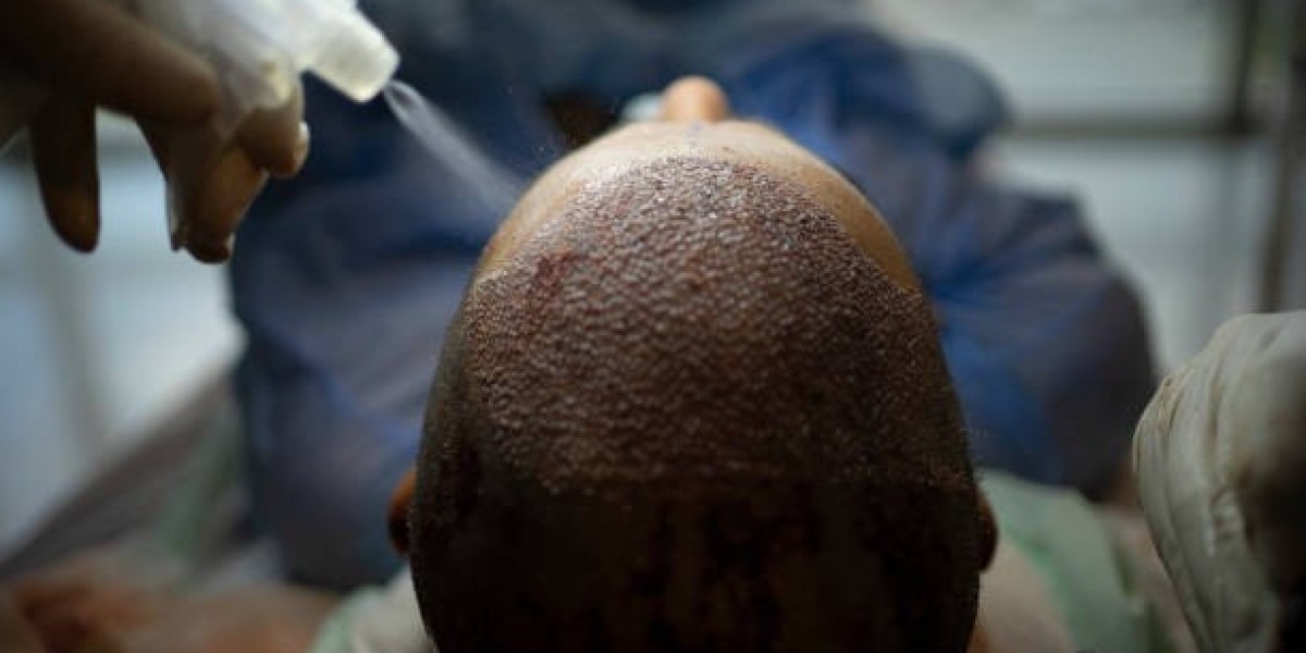 Hair Transplantation Techniques That Improve Hair Density