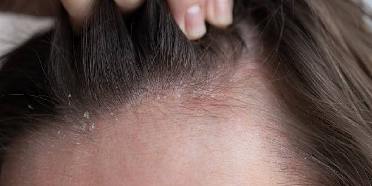 Natural Healing Power in Exosomes Therapy Hair