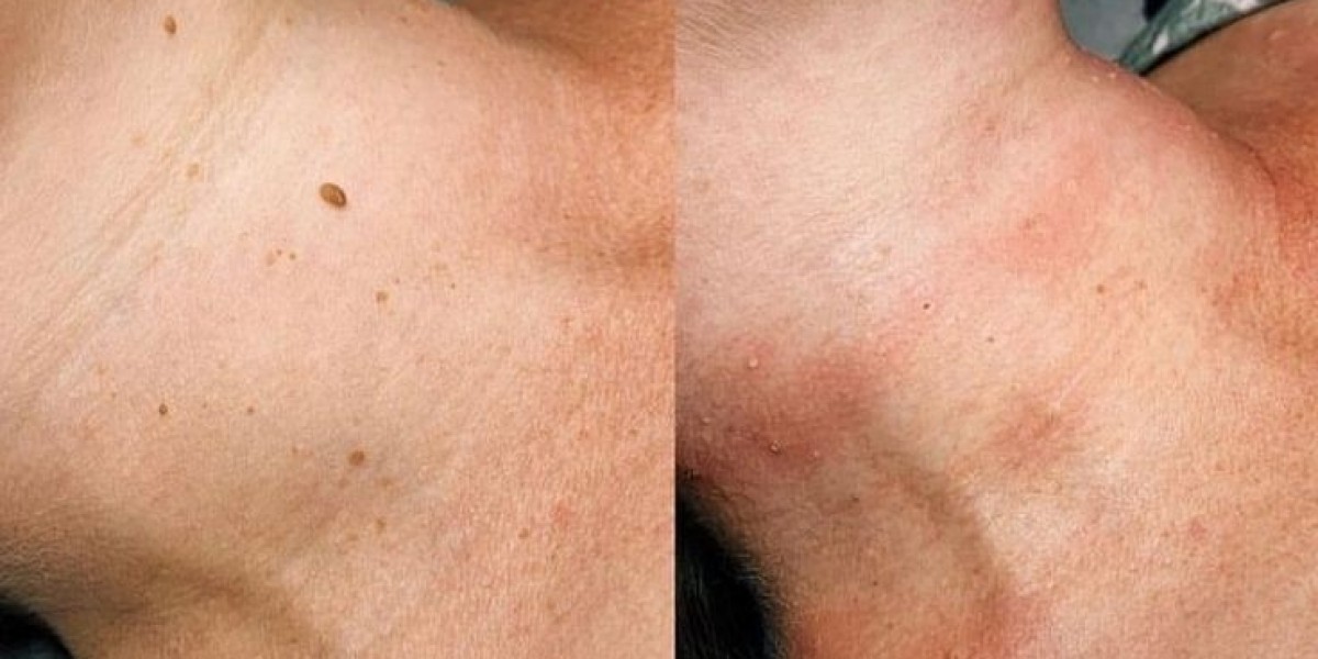 Medical-Grade Skin Tag Removal Treatment
