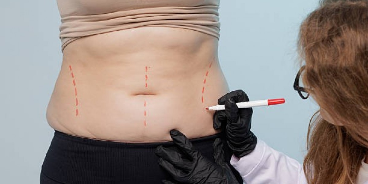 Understanding Liposuction Procedure for Targeted Fat Loss