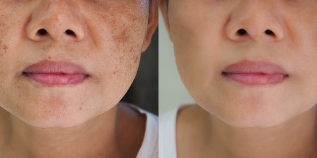 Understanding Modern Melasma Treatment in Dubai: A Comprehensive Guide