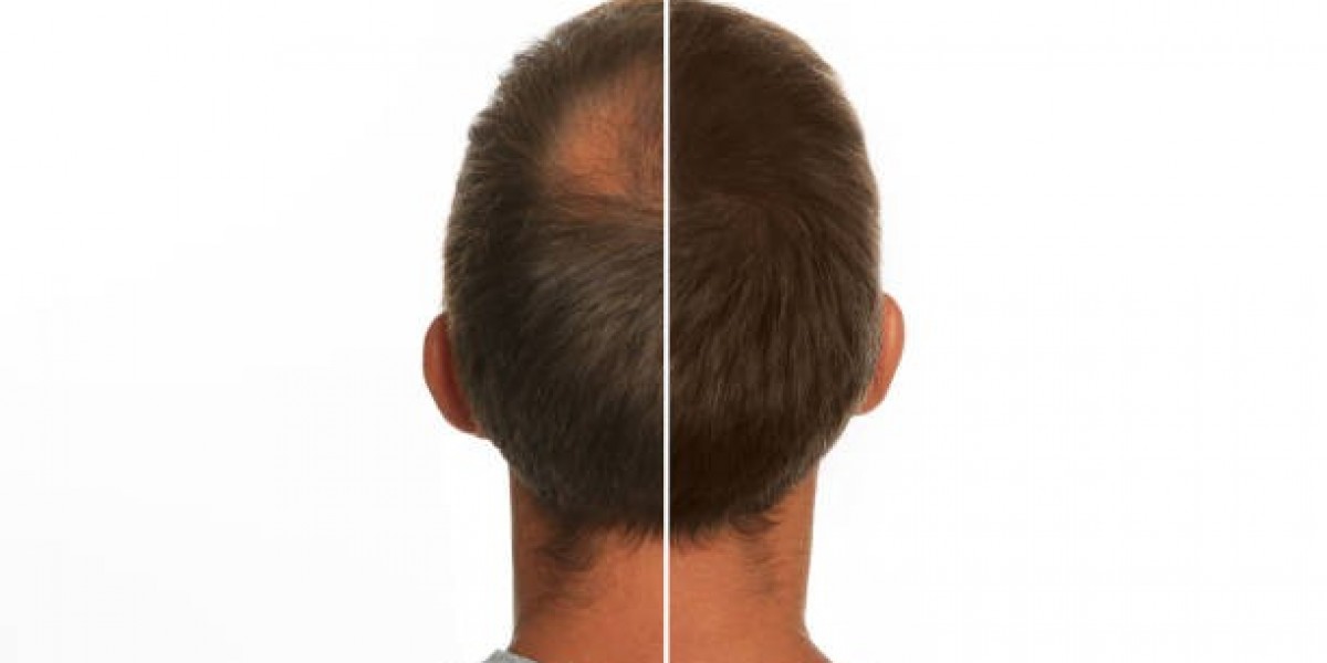 Hair Transplant in Riyadh Decision Factors