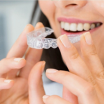 Why Clear Aligners Are a Top Choice for Smile Makeovers - Tumblrblog