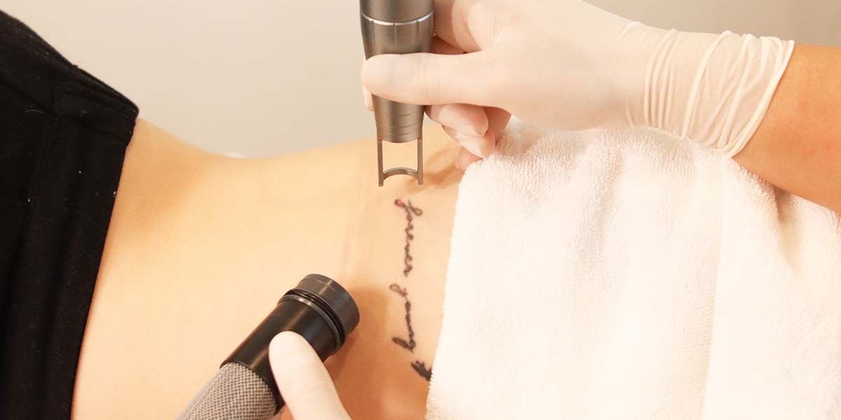 Fading the Past: A Complete Guide to Laser Tattoo Removal