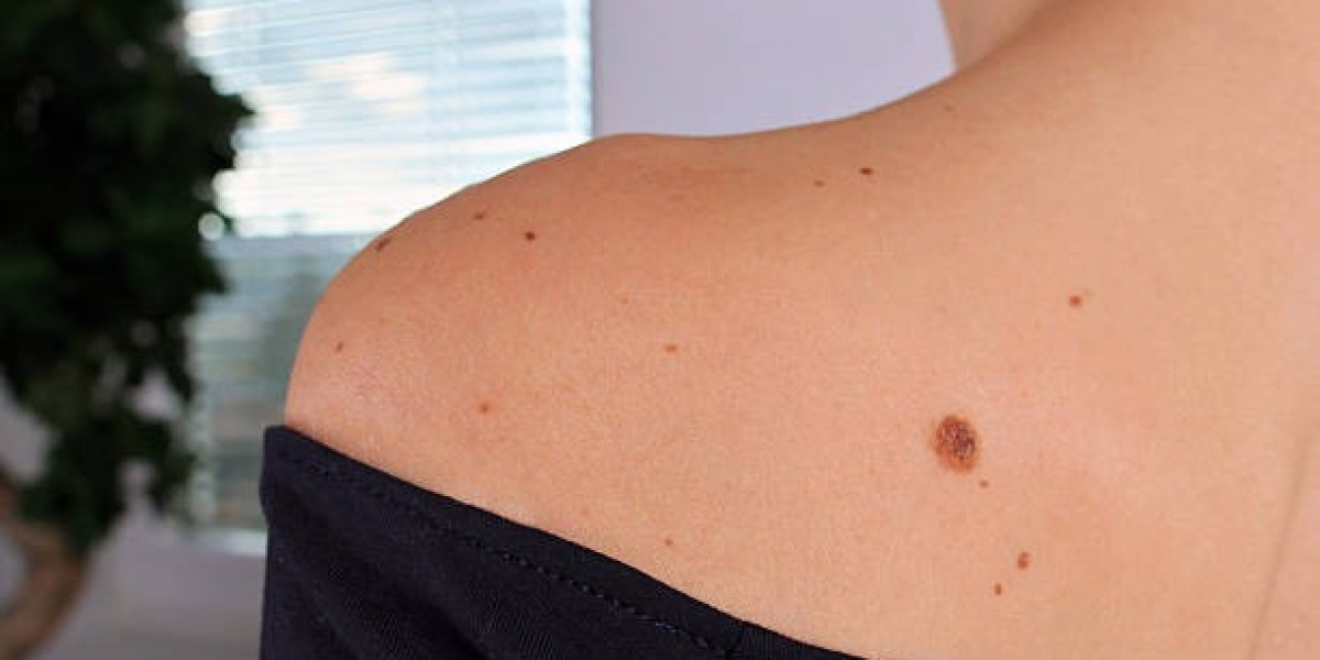 Understanding Skin Tags and Safe Removal Strategies