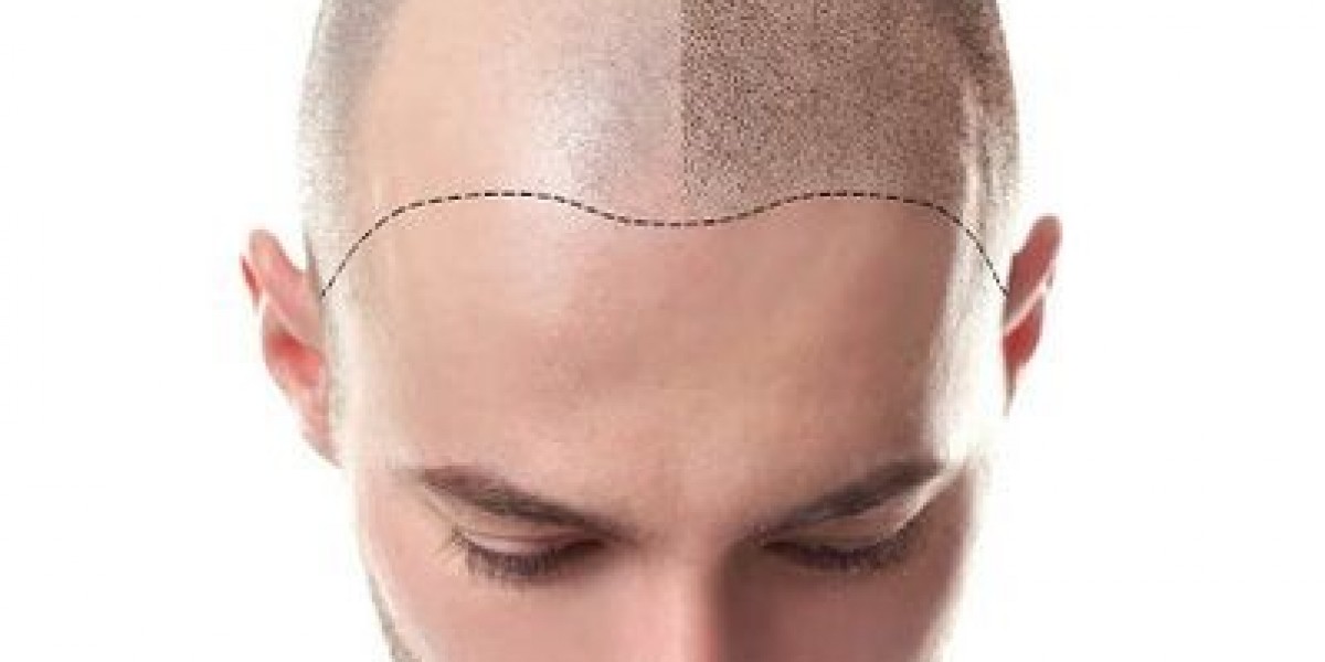 Advanced Hair Transplant in Riyadh Innovations Today