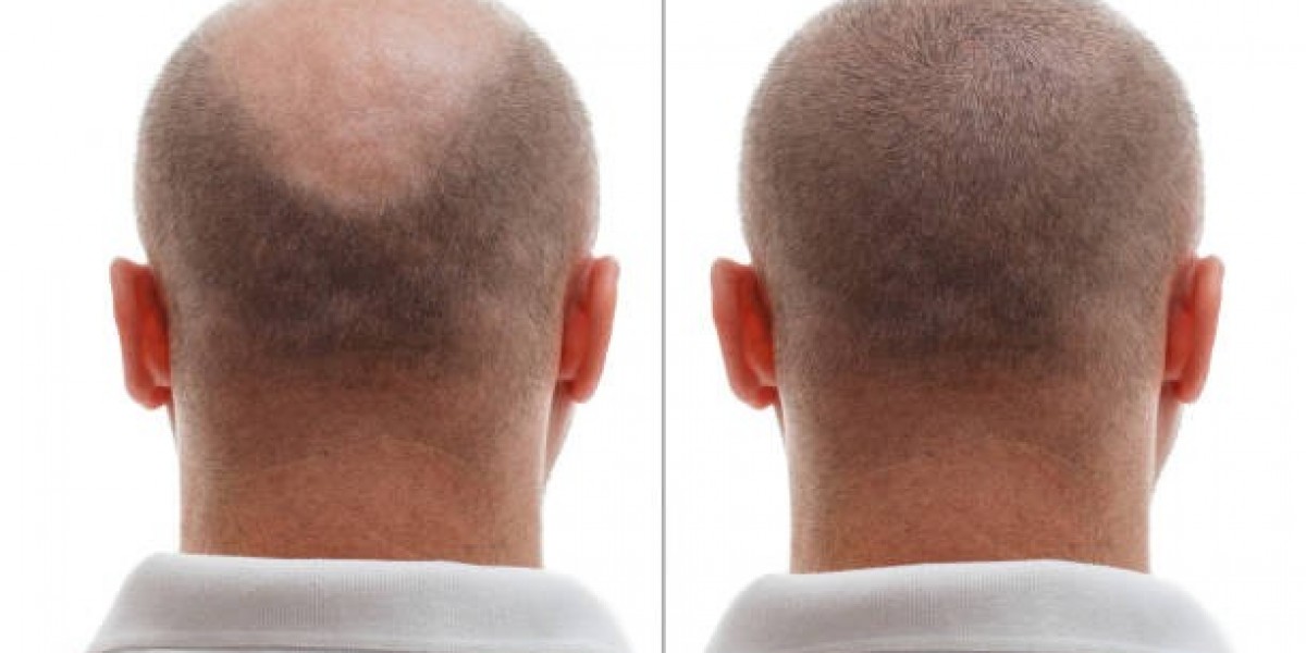 Hair Transplant Procedure Step by Step