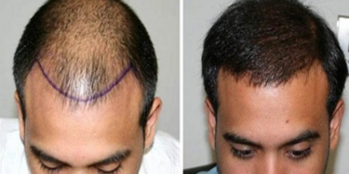 باقات زراعة الشعر في الرياض: خدمات VIP بأسعار تنافسية