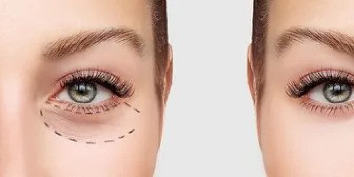 Eyelid Lift in Islamabad – Professional Cosmetic Care