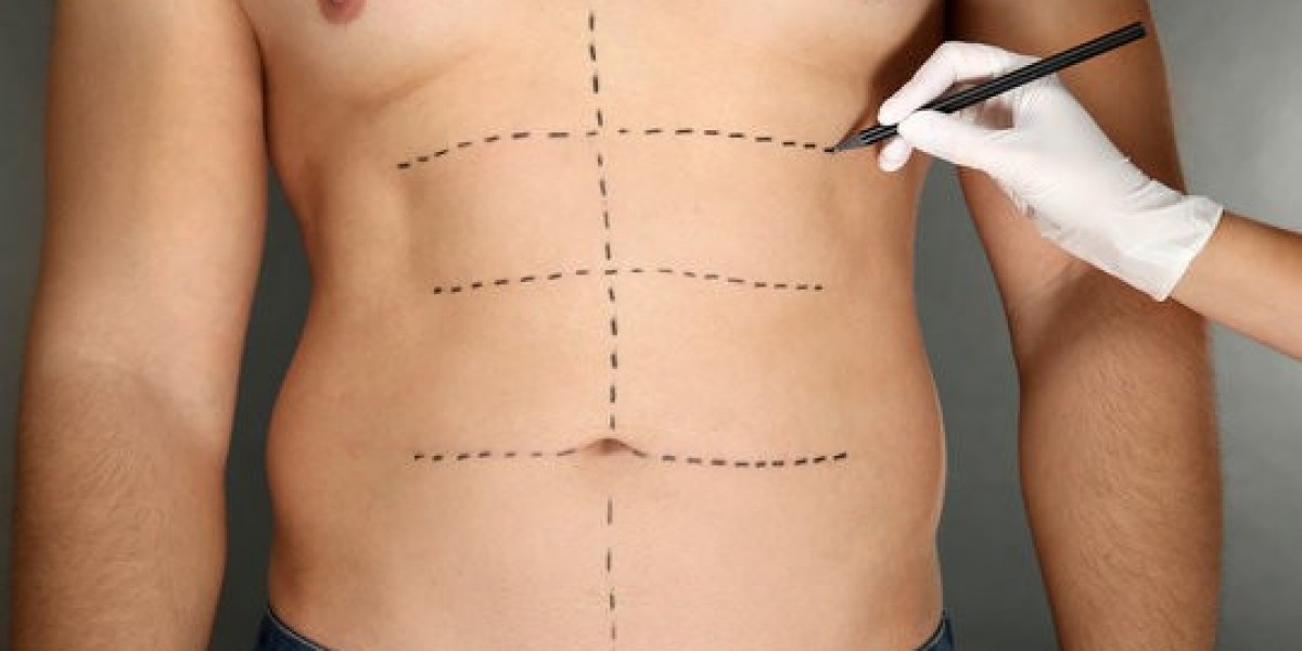 Defining the Masculine Profile with Liposuction Riyadh