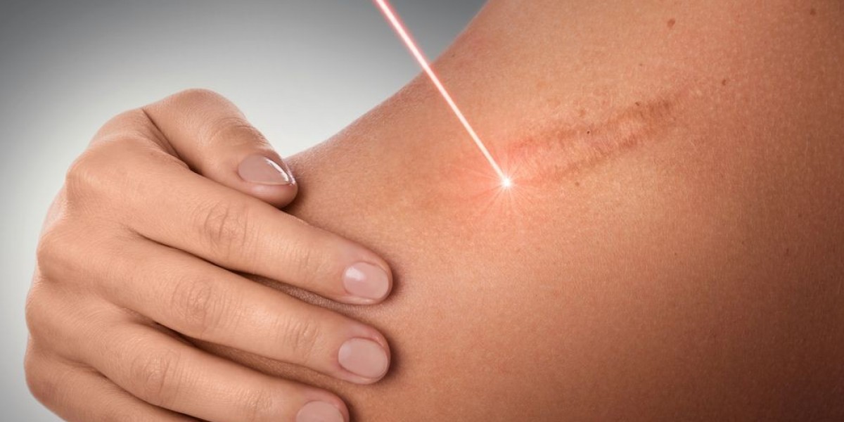 Royal Clinic’s Approach to Safe Laser Scar Removal