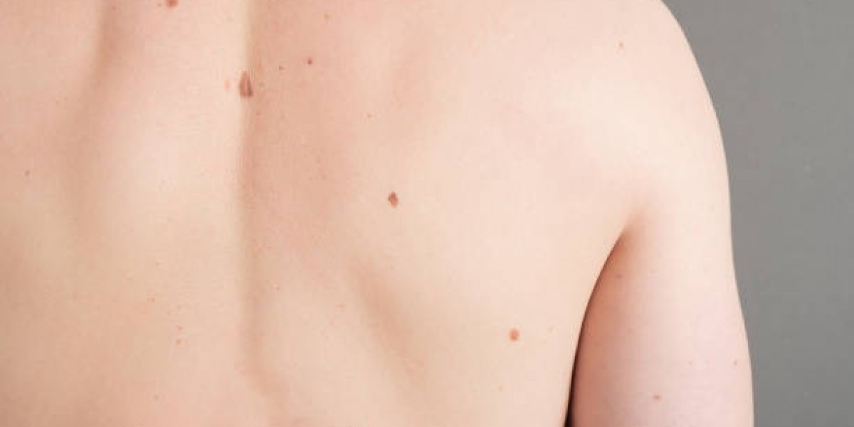 Mole Removal Methods That Support Skin Health