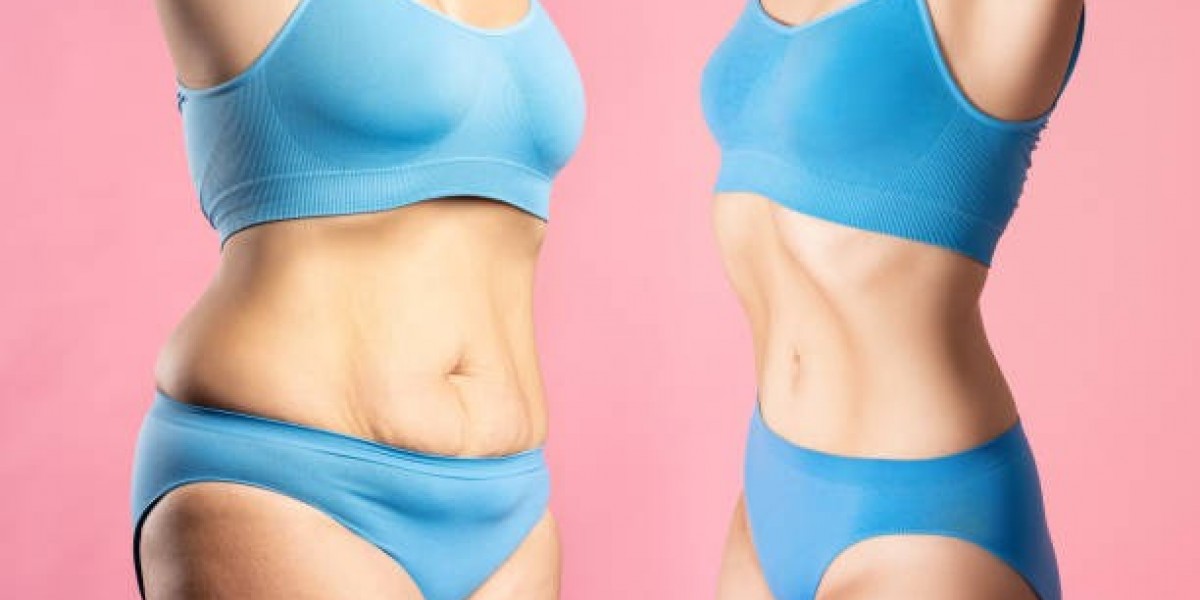 Recovery Tips After Liposuction Treatment in Riyadh