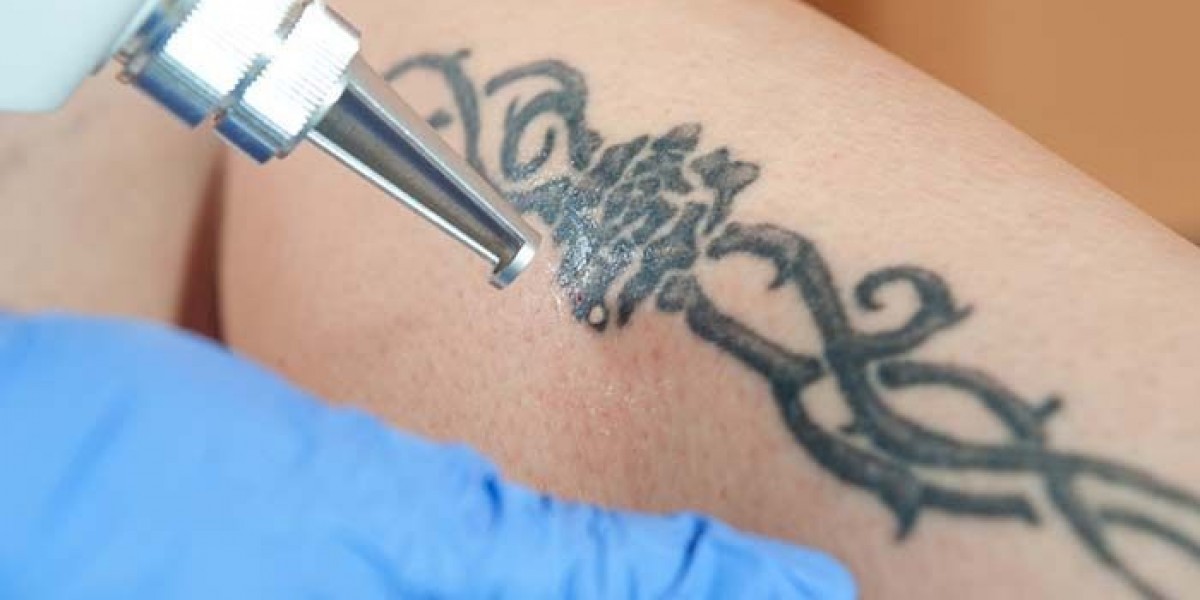Royal Clinic’s Modern Laser Tattoo Removal Solutions
