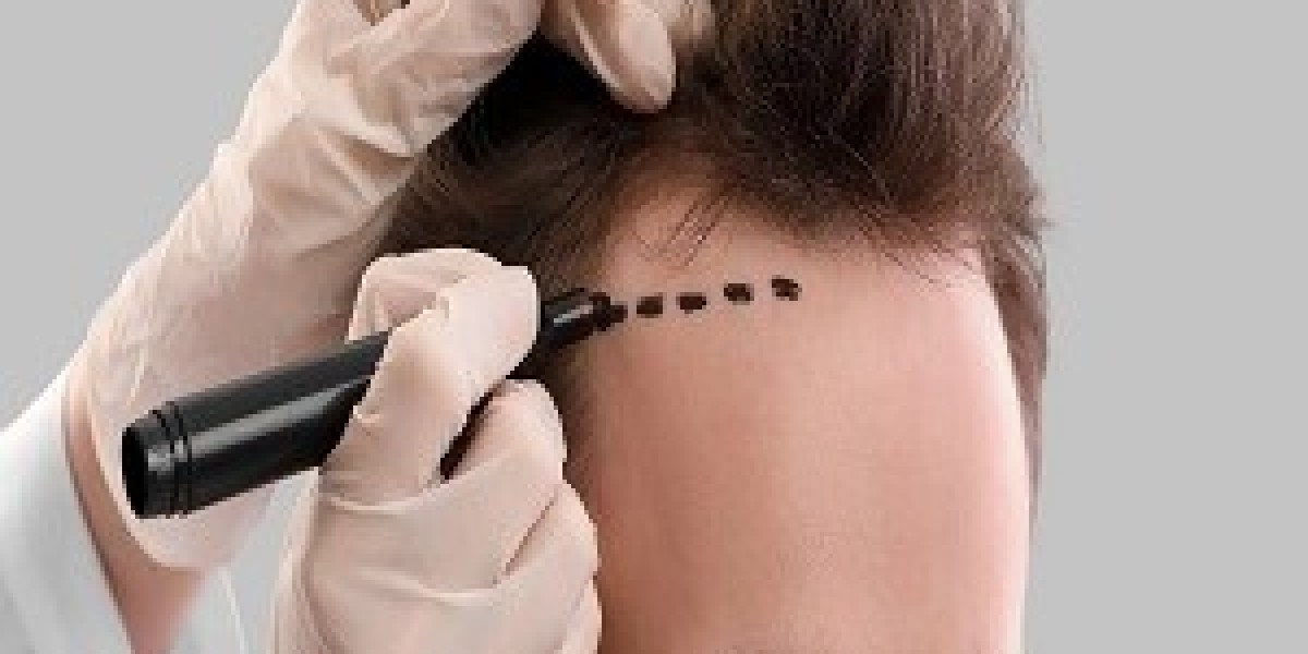 دليلك الشامل حول زراعة الشعر في الرياض: التقنيات، التكلفة، والنتائج