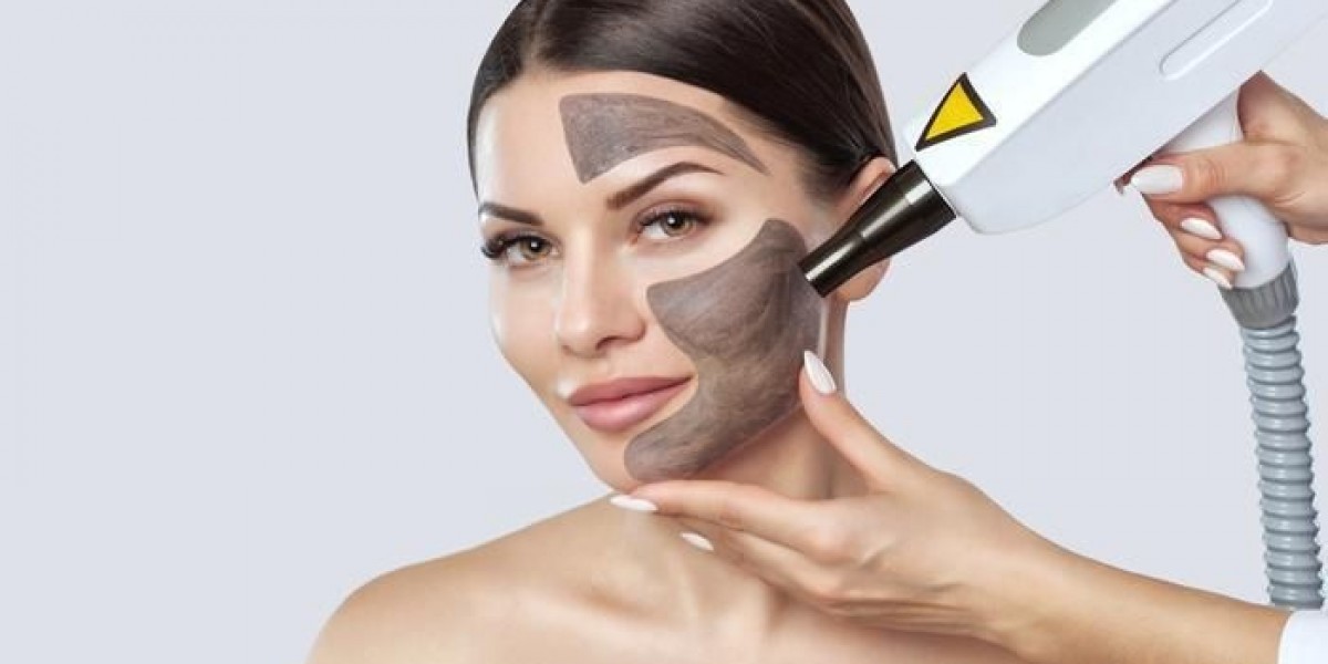 Laser Carbon Peel for a Fresh, Oil-Free Glow | Royal Clinic