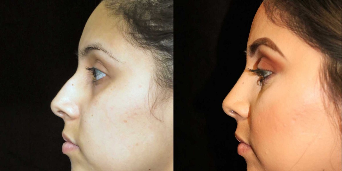 3D Imaging and Rhinoplasty in Riyadh: See Your Results Before Surgery