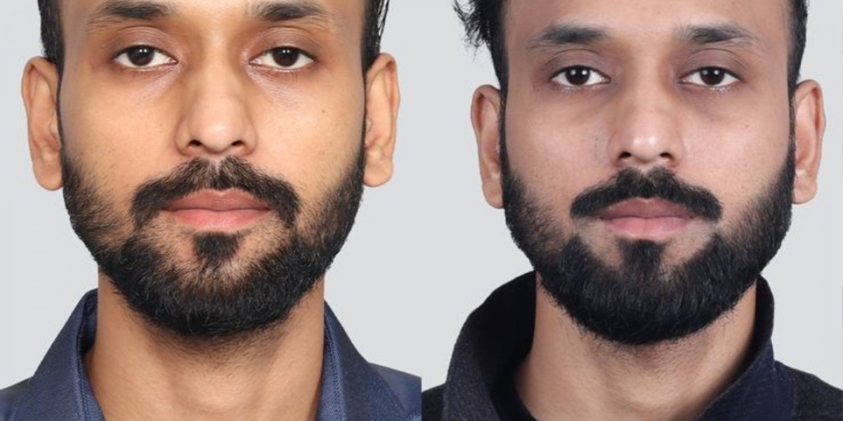 Advanced Dental Veneers in Islamabad