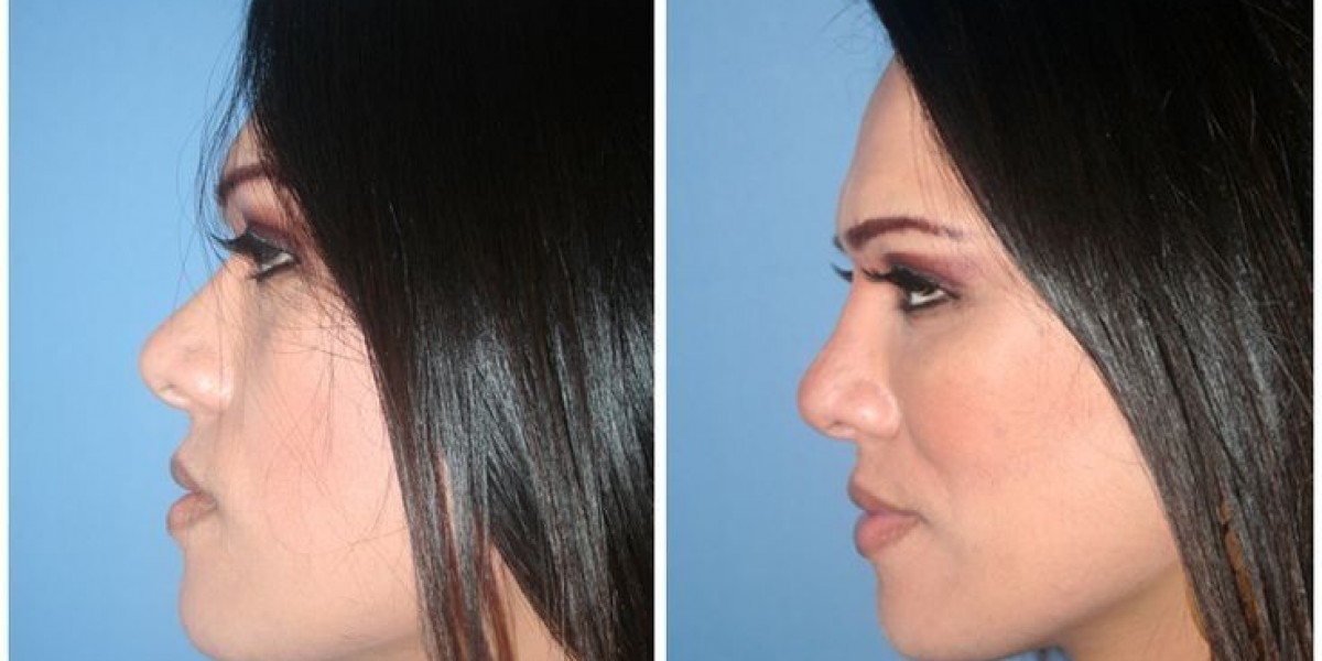 Jaw Surgery in Islamabad for Facial and Bite Correction